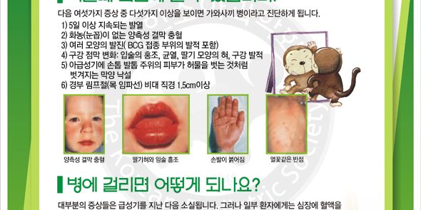 가와사끼 병